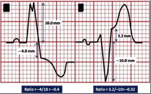 Modified-Sgarbossa-c-from-mattu-645x406